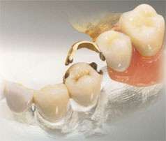 Ортопедия (восстановление утраченных зубов)
